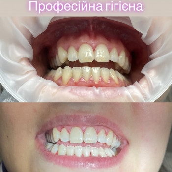 Професійна гігієна