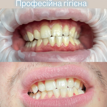 Професійна гігієна