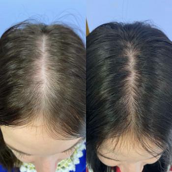 Трихологічна консультація з трихоскопією
                    Косметолог Катерина Винница