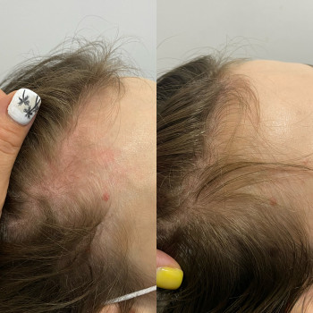 Трихологічна консультація з трихоскопією
                    Косметолог Катерина Винница