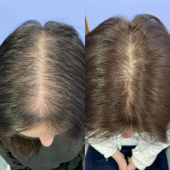 Трихологічна консультація з трихоскопією
                    Косметолог Катерина Винница