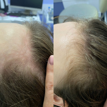 Трихологічна консультація з трихоскопією
                    Косметолог Катерина Винница