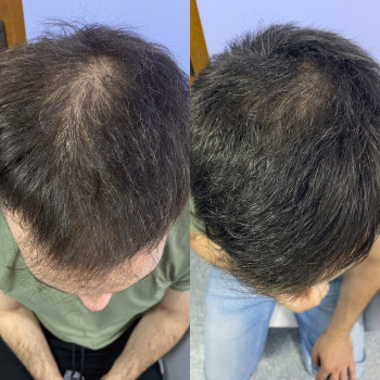 Трихологічна консультація з трихоскопією
                    Косметолог Катерина Винница