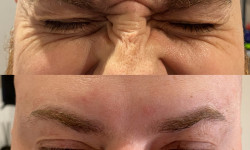 Ботулотерапія препаратом "BOTOX" Косметолог Катерина Винница