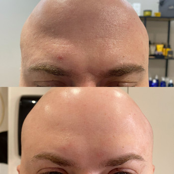 Ботулотерапія препаратом "BOTOX"
                    Косметолог Катерина Винница