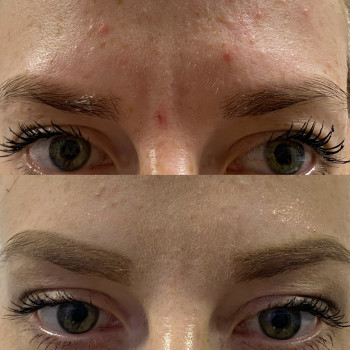 Ботулотерапія препаратом "BOTOX"
                    Косметолог Катерина Винница