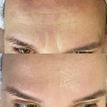 Ботулотерапія препаратом "BOTOX"
                    Косметолог Катерина Винница