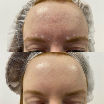 Ботулотерапія препаратом "BOTOX"
                    Косметолог Катерина Винница