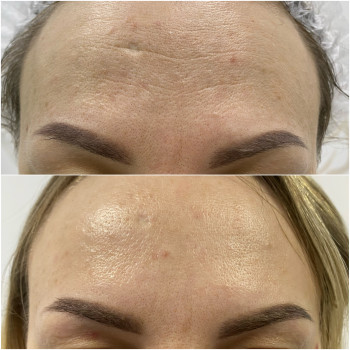 Ботулотерапія препаратом "BOTOX"
                    Косметолог Катерина Винница