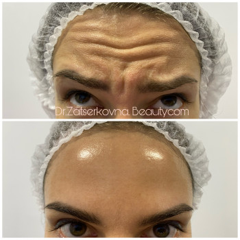 Ботулотерапія препаратом "BOTOX"
                    Косметолог Катерина Винница