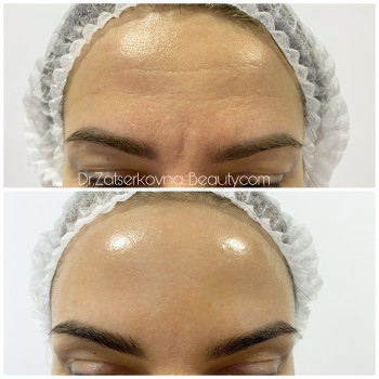 Ботулотерапія препаратом "BOTOX"
                    Косметолог Катерина Винница