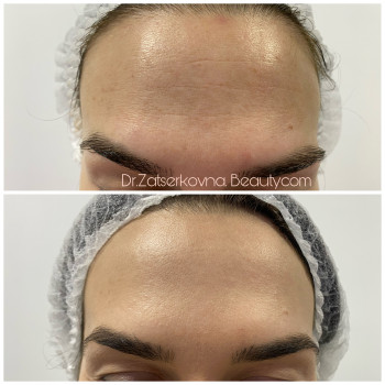 Ботулотерапія препаратом "BOTOX"
                    Косметолог Катерина Винница