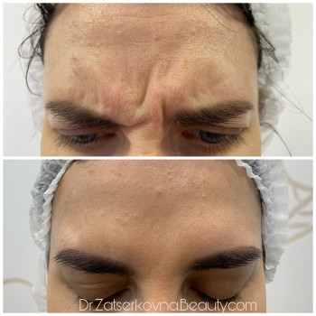 Ботулотерапія препаратом "BOTOX"
                    Косметолог Катерина Винница