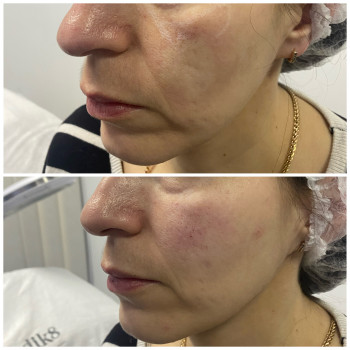 Контурна пластика (скули)
                    Косметолог Катерина Вінниця