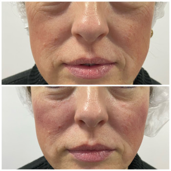 Контурна пластика (скули)
                    Косметолог Катерина Вінниця