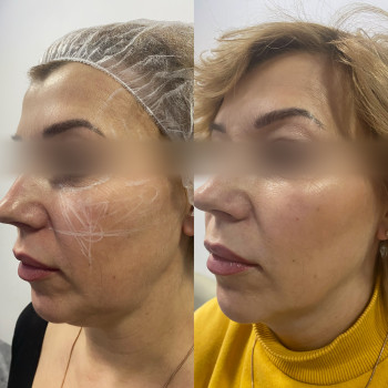 Контурна пластика (скули)
                    Косметолог Катерина Вінниця