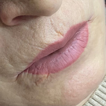 Загоєні 6 місяців