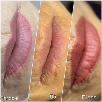 Загоєні без корекції,до,та одразу після процедури