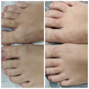 Электроэпиляция
                    Майстер депіляції Ксения Одеса