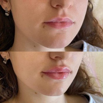   пластика губ  smile