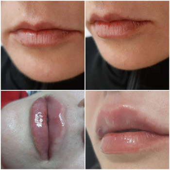   пластика губ