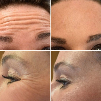  #Ботулінотерапія