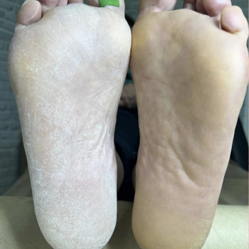 Гіперкератоз