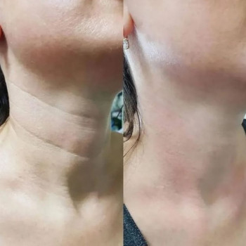 Ботокс платизми шиї. ( розслаблення)