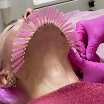 Армування зони підборіддя #тредліфтингсуми #фотографсумы #фотографсуми #весіллясуми  #перманентсуми