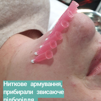 Процедура обідньої перерви, ефект до 18 міс