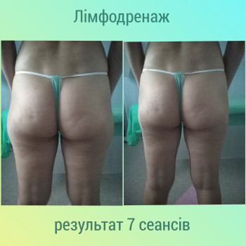  #лімфодренажкиїв
 #лімфодренажниймасаж #протинабряеів #скинутивагу #оздоровчиймасаж