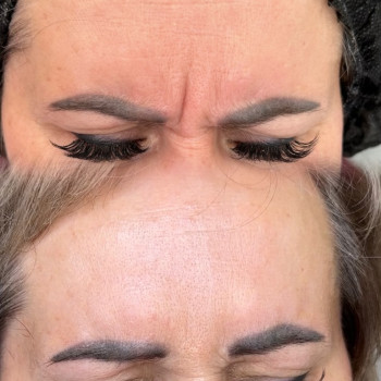 Ботокс
                    Мастер эпиляции Янітта Киев