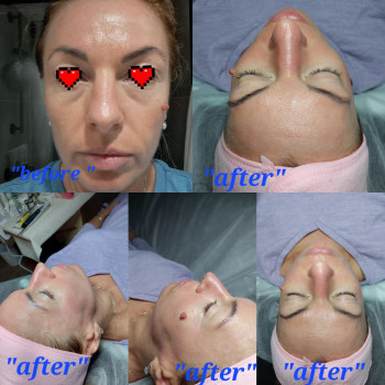 Результат "до" и сразу после первой процедуры Фракционной Мезотерапии.