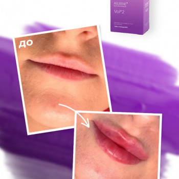 Збільшення губ
                    Косметолог-инъекционист Виктория Полтава