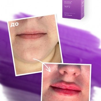 Збільшення губ
                    Косметолог-инъекционист Виктория Полтава