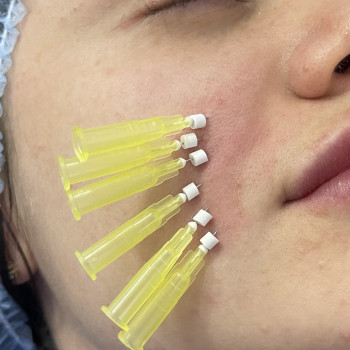 Мононити; нитевой лифтинг; мононитки
                    Майстер епіляції Янітта Київ