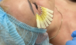 Мононитки; нитковий ліфтинг; мононити Косметолог-эстетист Янітта Вышгород