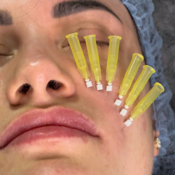 Мононитки; нитковий ліфтинг; мононити
                    Косметолог-естетист Янітта Вишгород