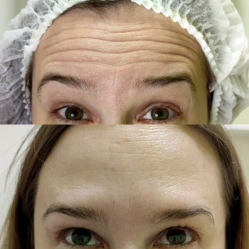 Ботулинотерапия
                    Косметолог Мария Харків