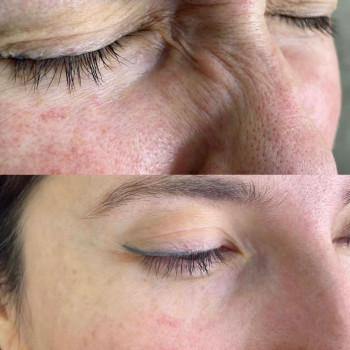 Ботулинотерапия
                    Косметолог Мария Харків