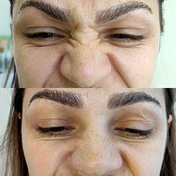 Ботулинотерапия
                    Косметолог Мария Харків