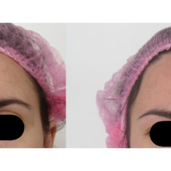 5 пр. Без ін'єкцій!!! Розгладження зморщок