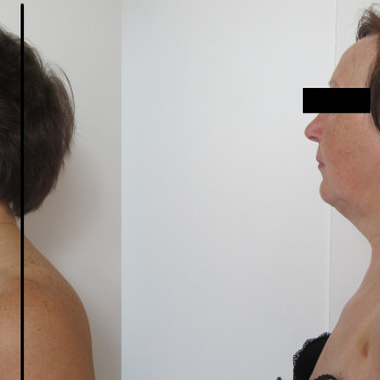 7 пр.Виправлення статики шиї.Ліфтинг щік.