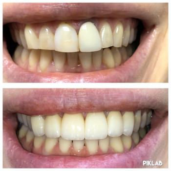 Поєднання коронок та вінірів