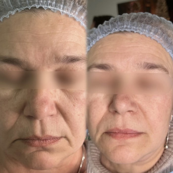 Нити; нитковий ліфтинг; мононитки
                    Косметолог-естетист Янітта Вишгород