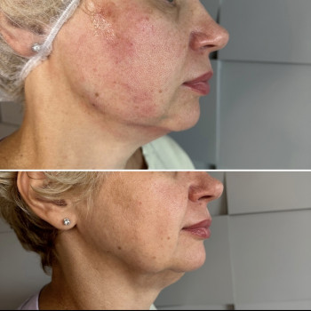 Мононитки; нитковий ліфтинг; мононити
                    Косметолог-естетист Янітта Вишгород