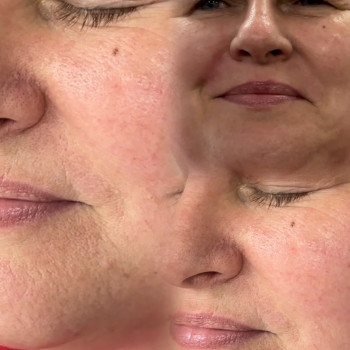 Мононитки; нитковий ліфтинг; мононити
                    Косметолог-естетист Янітта Вишгород