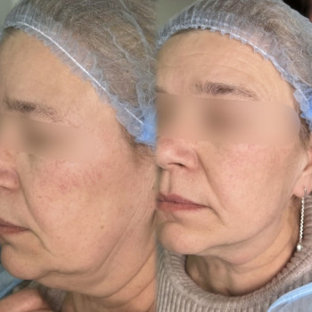 Мононитки; нитковий ліфтинг; мононити
                    Косметолог-естетист Янітта Вишгород