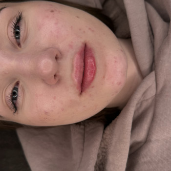 1мл, кололи за два рази