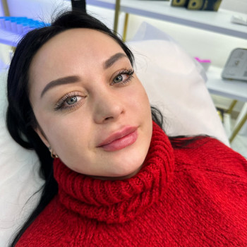 Збільшення губ
                    Косметолог Татьяна Вінниця